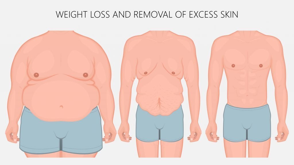 Body Contouring Surgery VS Weight Loss Surgery