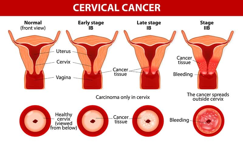 What causes cervical cancer?