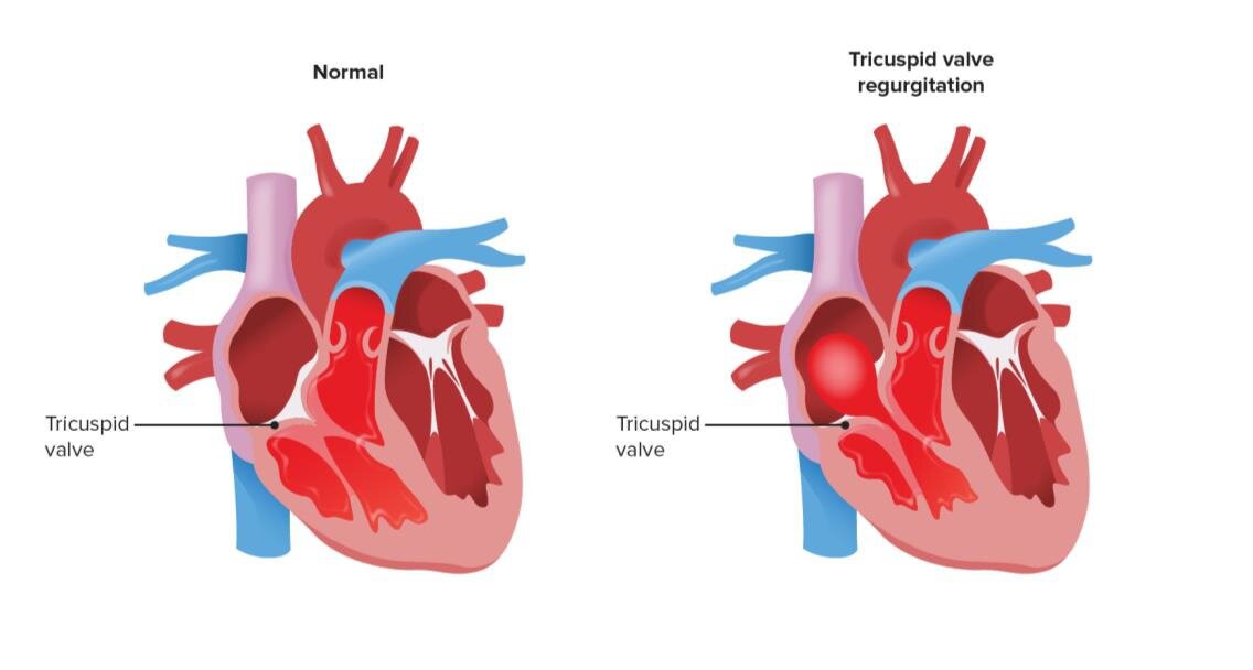 Advancements in Heart Valve Replacement