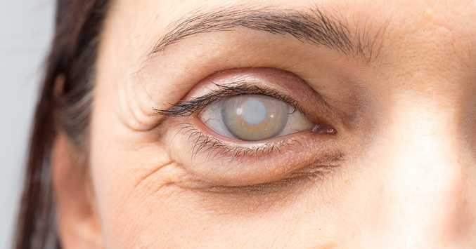 Cataract Surgery