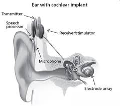 Cochlear Implant cost in India