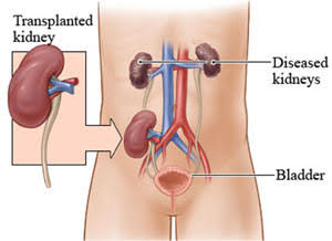 kidney transplant cost in india