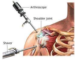 Shoulder Replacement Cost In India