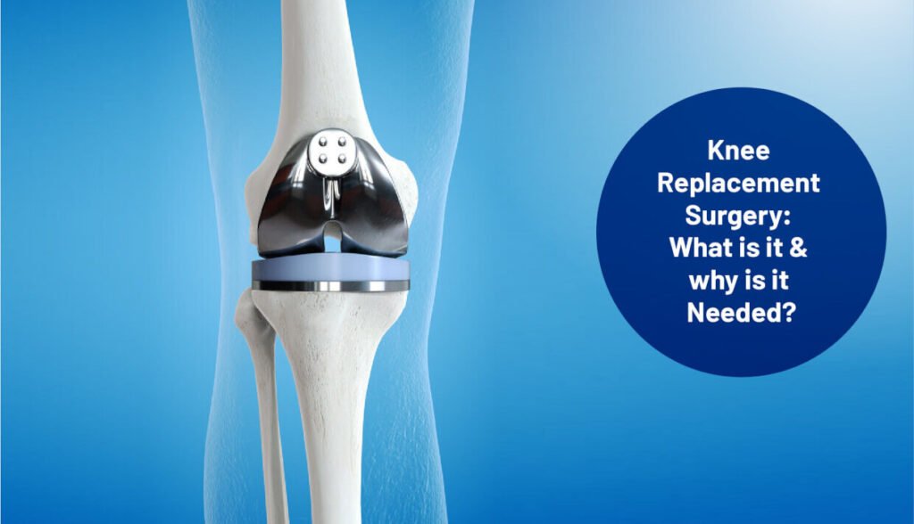signs you need a knee replacement