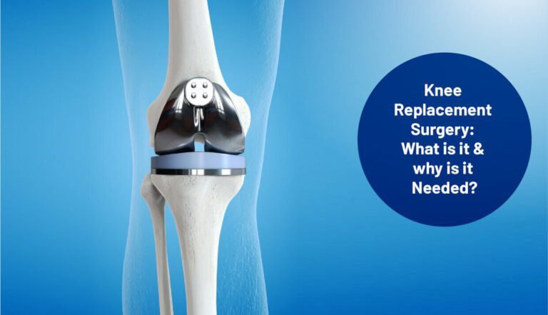 7 Signs You Might Need Knee Replacement Surgery | Medserg