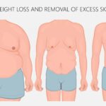 Body Contouring Surgery VS Weight Loss Surgery