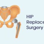Advanced Total Hip Replacement Implant India