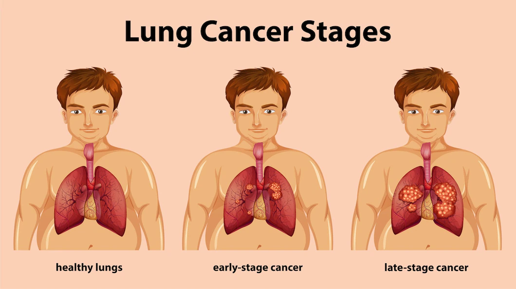 10 Signs And Symptoms Of Lung Cancer Medserg 