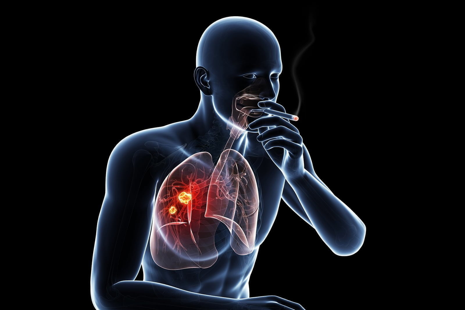How Timely Diagnosis At Right Time Can Avoid Complications Of Lung Cancer?