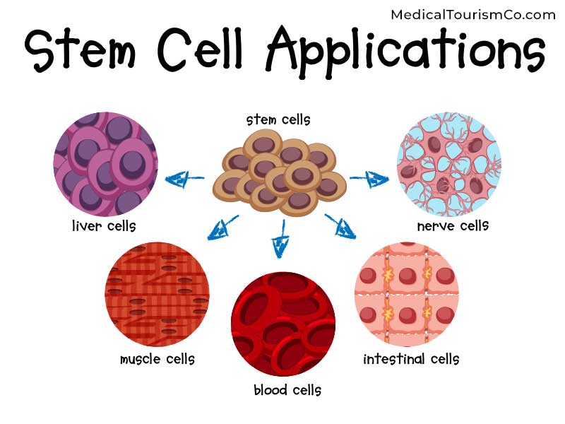 Is Stem Cell Therapy For Diabetes The Future Treatment?