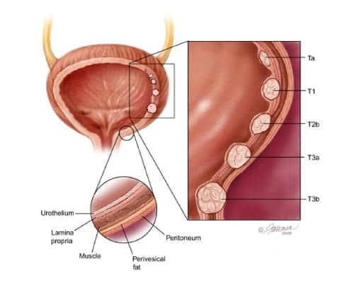bladder cancer treatment in india