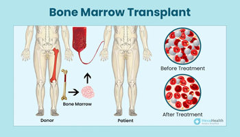 Bone-Marrow-Transplant